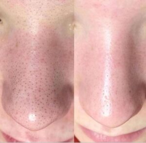 limpeza-de-pele-antes-e-depois